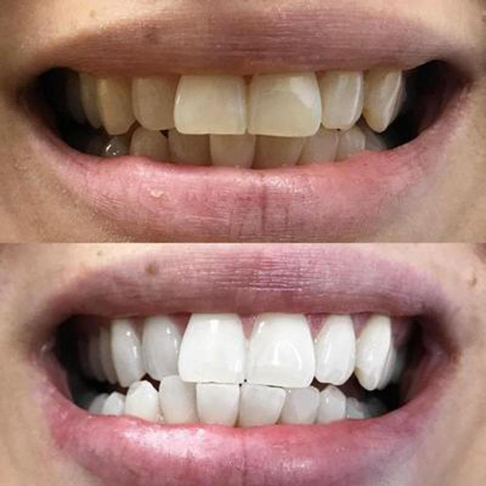 Whitening strips